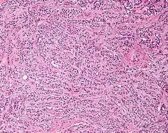 Low magnification micrograph of a Sertoli cell tumour. H&E stain.