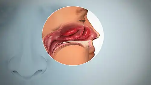 نمای کناری از سینوسهای بویایی که تورم غشاء مخاطی را نشان میدهد.