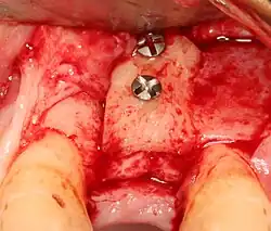 استخوان گرفته شده از محل دیگری (معمولاً پشت فک پایین) میتواند در صورت نیاز به مقدار بیشتری استخوان، در همان فرد به محل ایمپلنت پیوند زده شود.