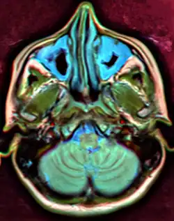 تصویر MRI که سینوزیت را نشان می‌دهد. ادم و ضخیم شدن مخاط در هر دو سینوس ماگزیلاری ظاهر می‌شود.