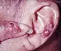 توفوس نقرسی که به صورت ندول روی انگشت و مارپیچ گوش ظاهر می‌شود