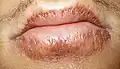 لبهای خشکیده و ترک خورده