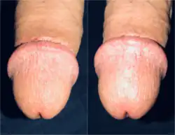 برانگیختگی سرنره