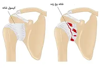 کپسول شانه سالم و شانه یخ زده