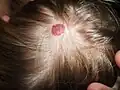Hemangioma on the scalp of a two-year-old female, in the "rest stage"