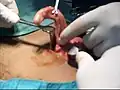 بالا نگه داشتن آپاندیس توسط کلمپ بابکوک