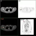 F-18 FDG PET/CT: متاستاز سرطان سینه به کتف راست