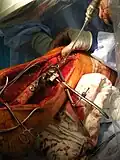 فیکس کردن به وسیله پیچ و پلاک