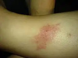 گزش شن‌مگس