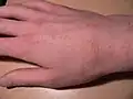 روز دوازدهم، تحت درمان
