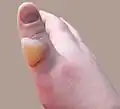Second degree burn of the thumb