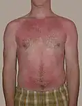 A sunburn is a typical first degree burn.