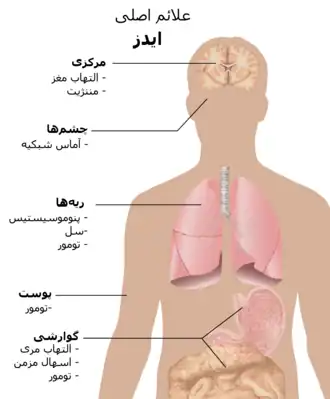  تصویر نیم تنه انسان که در آن شایع‌ترین علائم ایدز مشخص شده است