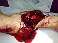 شکستگی باز استخوان ساق پا
