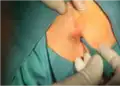 جراحی کم تهاجمی ترفین/بیوپسی پانچ برای بیماری پیلونیدال (۱)