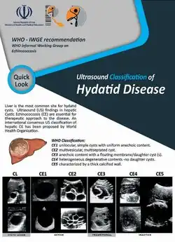 WHO-IWGE ultrasound classification of hydatid cysts